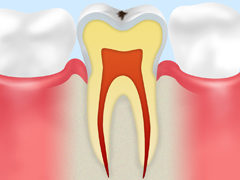 C0 【ごく初期の虫歯】 