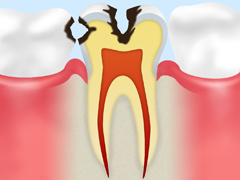 C2 【象牙質の虫歯】