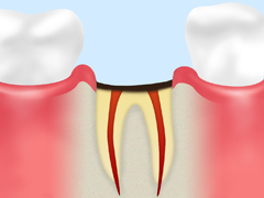 C4 【歯根まで達した虫歯】 