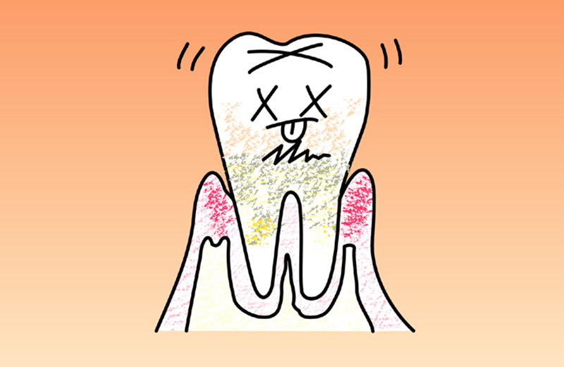 歯周病は実は油断できない病気です
