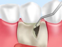 歯周外科手術